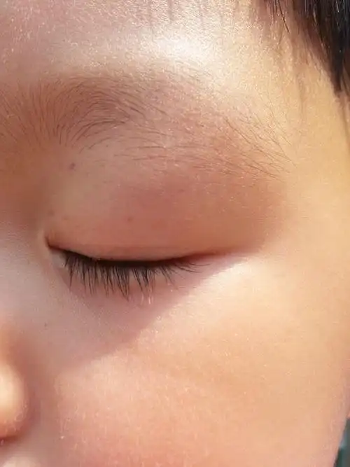 女儿三岁三个月 早上发现眼周围有红点 耳后也有 但是没有眼周围的