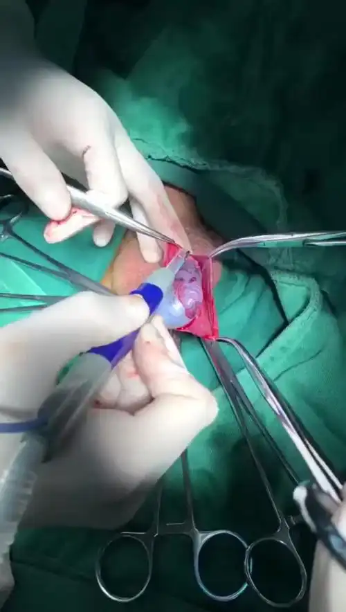 又一例睾丸扭转,精索扭转五圈.