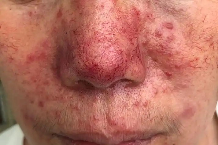 酒糟鼻初期症状图片_有来医生