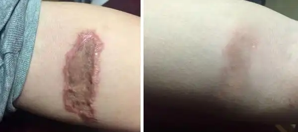 植皮疤痕怎么治疗