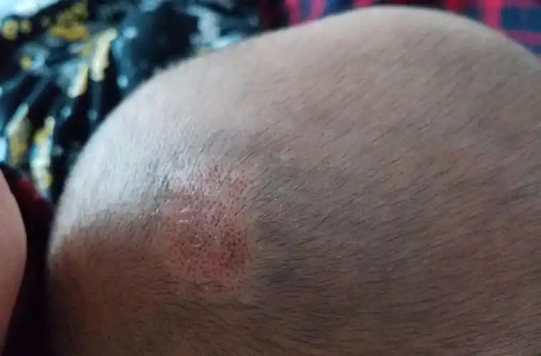 p> a href="#" data-lemmaid="603357">脂溢性皮炎 /a>结痂型:为油腻