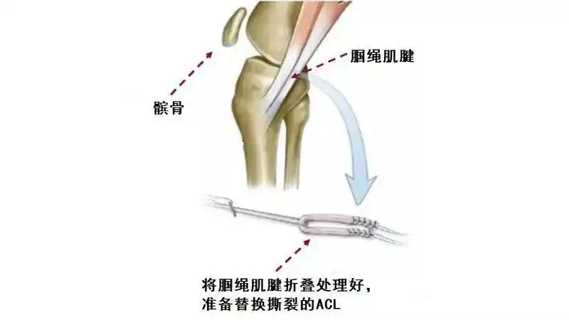 由于腘绳肌肌腱的弹性大于原装韧带,为了实现原有的固定功能,限