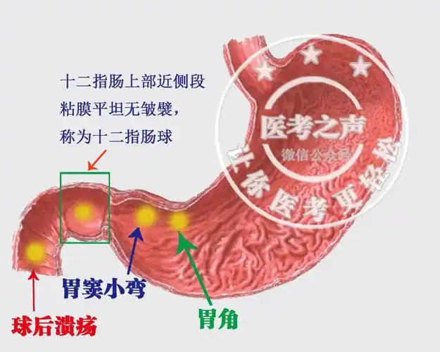 医考之声—考点提醒胃溃疡好发部位:胃角和胃窦小弯十二指肠好发部位