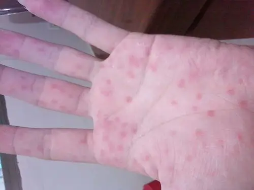 手心出现很多红点,还有脱皮还有点刺痛.是怎么回事啊?