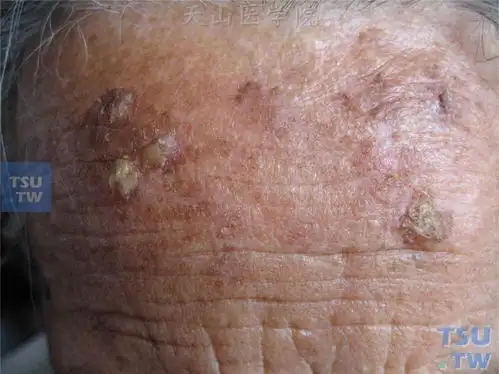 前额形状不规则斑片,基底微微发红,表面粘着性鳞屑,部分较硬,呈疣状