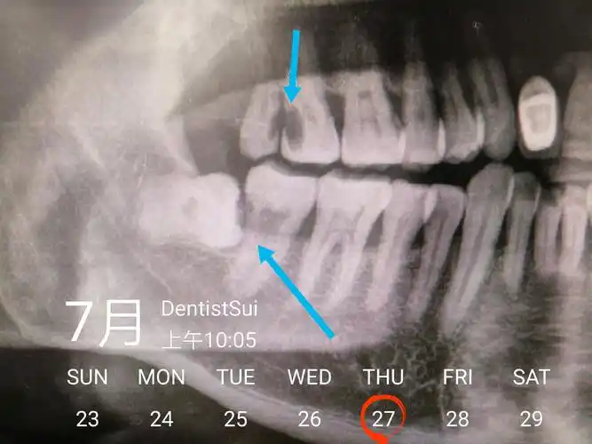 上颌长智齿到底该不该拔掉? - 好大夫在线