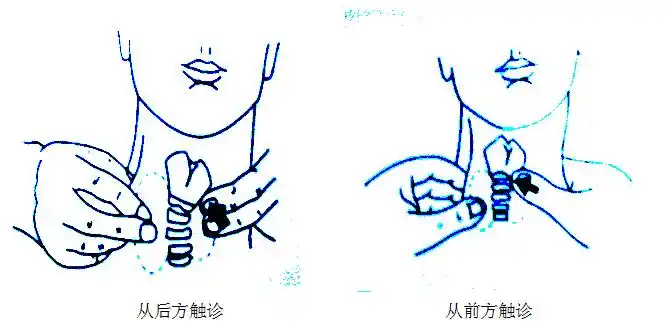 从后方触诊 从前方触诊甲状腺肿大分度:甲状腺不能看到,但能触及为i度