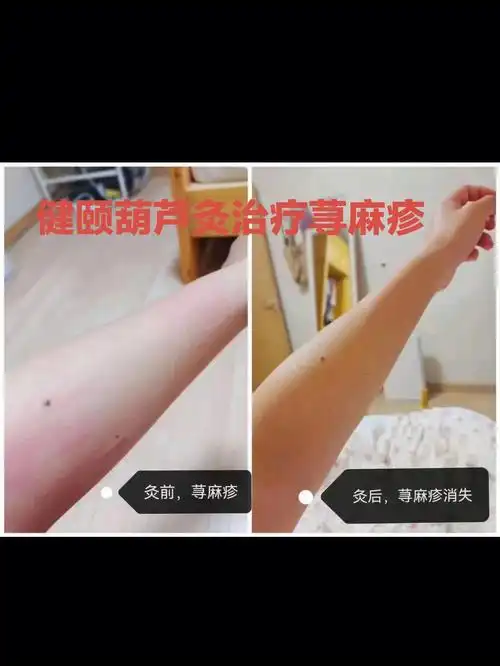 健颐葫芦灸治疗荨麻疹