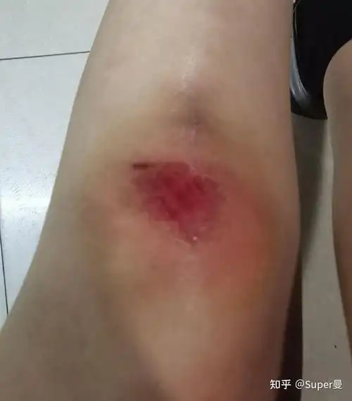 擦伤湿性愈合恢复日记