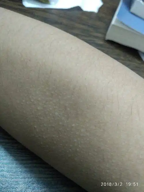 胳膊鸡皮疙瘩莫名其妙痒(胳膊上鸡皮疙瘩很痒怎么回事)