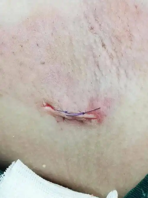 病例分享陕西省渭南惠康医院微创手术联合聚桂醇治疗腋臭