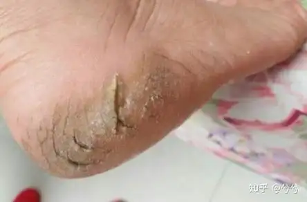 角化型和水泡型足癣怎么彻底治疗