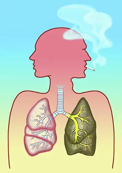 吸烟带给我"痛苦之旅"