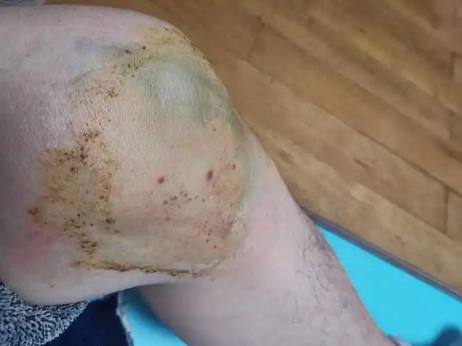 风青阳左侧膝关节内侧副韧带损伤外侧半月板裂伤治疗记录20200110