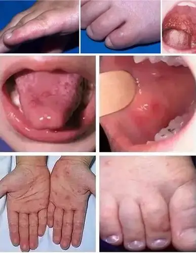 快看你家孩子身上有没有这种小红疹近期手足口病进入高发期