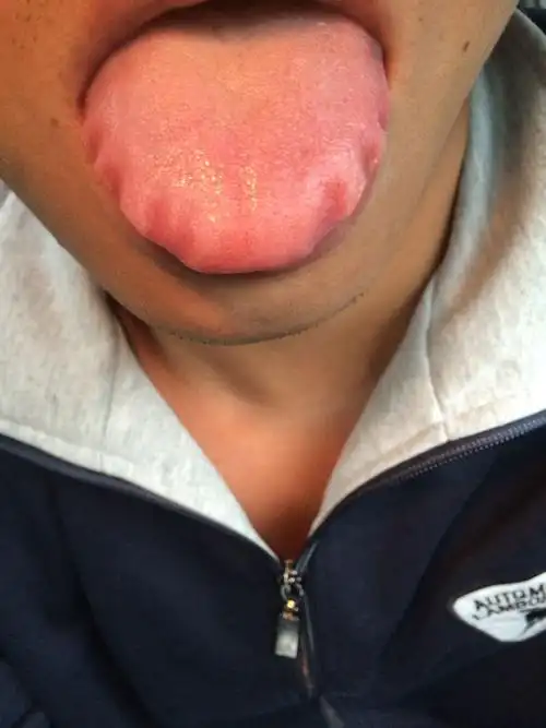 我这舌头已经一个多月这样子了,医生说不是口腔溃疡但是又不知道是