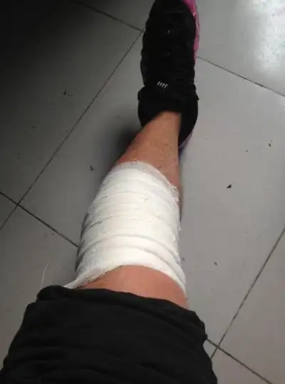 真实腿部受伤图片 (17)_有来医生