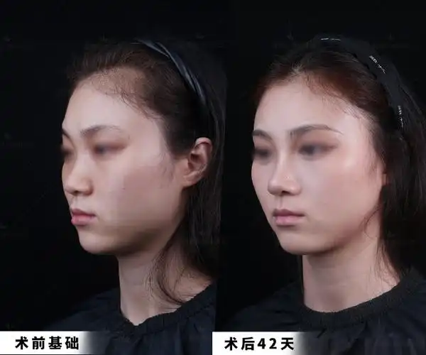 广州隆鼻##小部位大改变