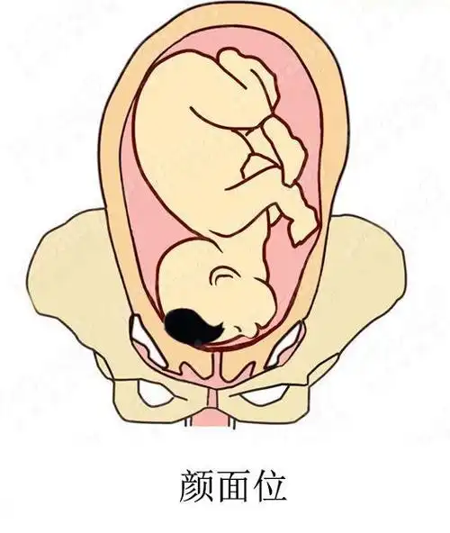 胎儿是这四种胎位孕妇分娩时要当心
