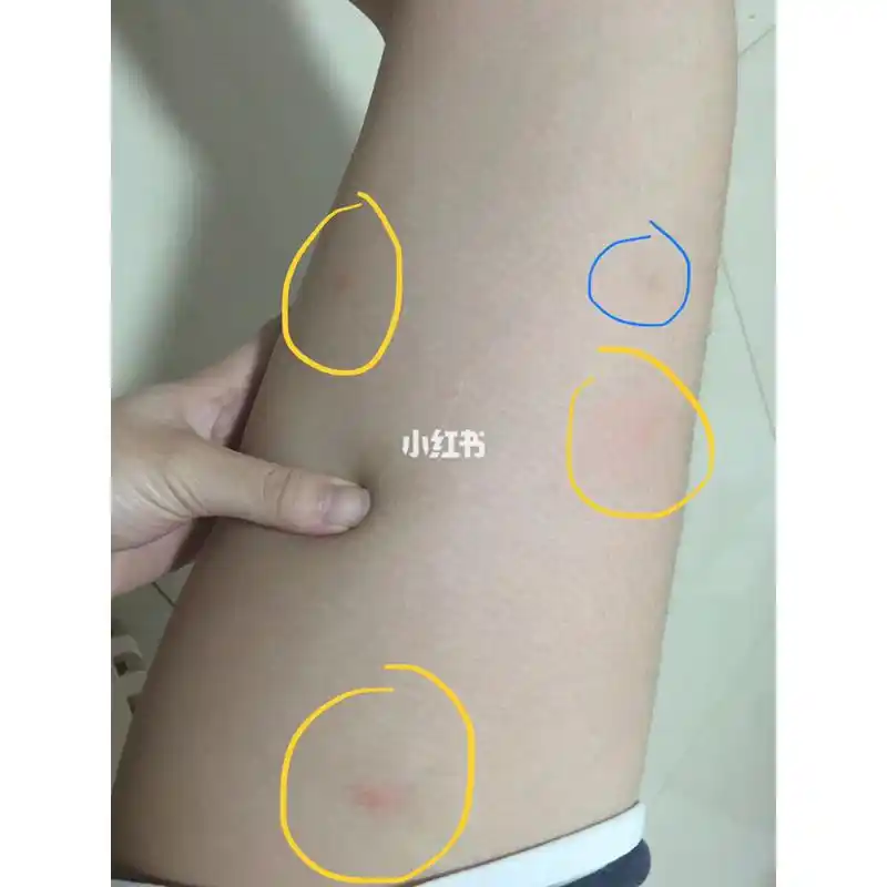 好像是虫咬性皮炎?用个药膏居然效果挺好