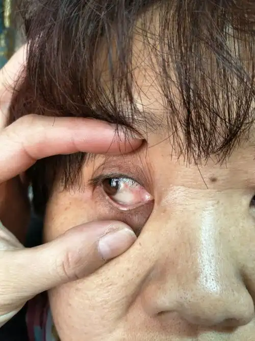 豫北纺织大世界 张桂花 胬肉迎风流泪眼磨