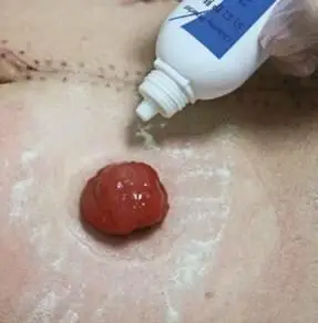 造口袋的日常更换流程_肠梗阻_治疗方式_日常注意事项 - 好大夫在线