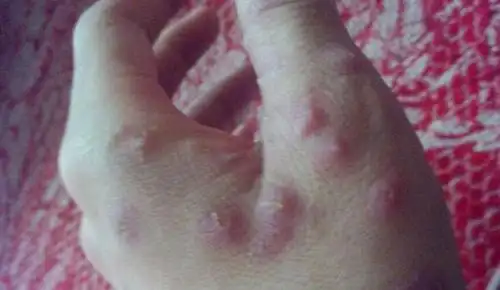 梅毒图片_梅毒症状表现图片大全_有来医生