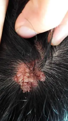 我儿出生时头顶被医生剪刀碰伤,现长出很多息肉,我儿是九八年生的