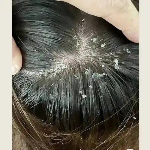 【头屑产品使用心得分享】_头皮_头发_问题