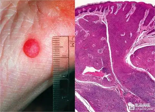 镜下:和表皮相连,细胞温和一致,可见细胞间桥,腔隙分化,诊断为汗孔瘤.