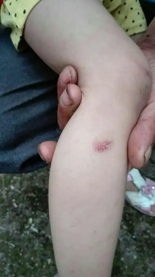 宝宝腿上有红疙瘩图片是不是血管瘤看看