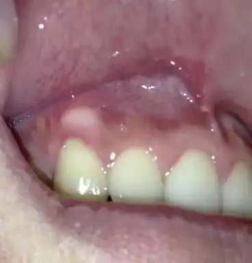 牙槽骨很突出不敢大笑怎么办该怎么解决