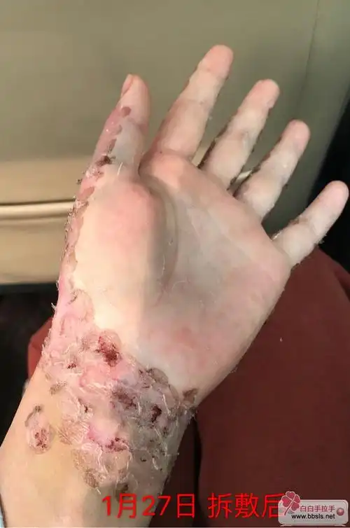 表皮移植10天后拆敷12月17日手术到今天刚好一个月