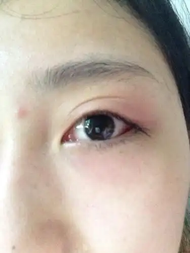 好难受 2014-06-12 张建强 医师 怀孕五个月眼睛严重过敏肿的很大很痒