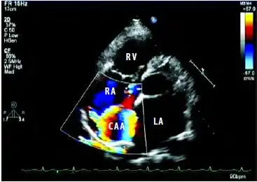 彩色多普勒超声诊断右冠状动脉右房瘘合并右房内冠状动脉瘤1例