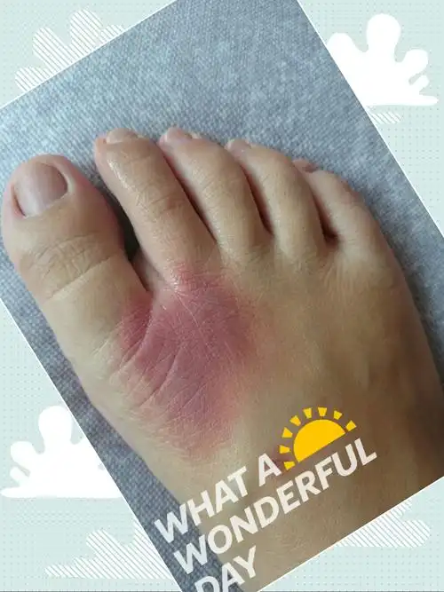 脚上肿了一块,红的发紫,痒,挠了又通,是什么回事.