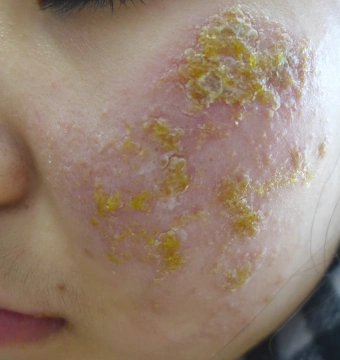 18岁面部湿疹女孩恢复美丽容颜