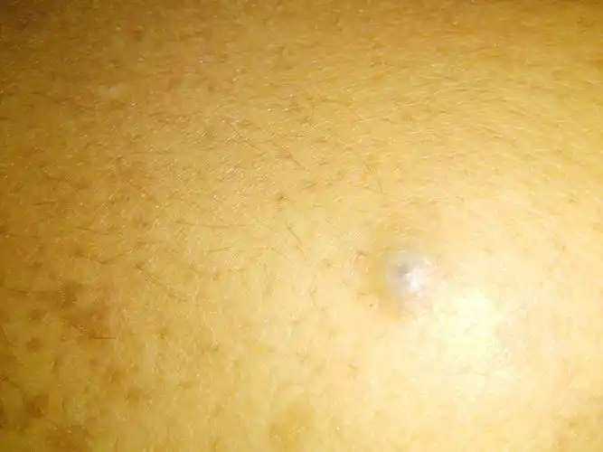 皮肤科,寻医问药.身上出了一个疙瘩,在背颈出,请教专家,神魔情况