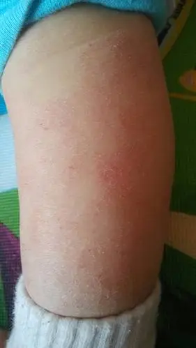 一岁孩子经常全身红痒,腿比较多,胳膊……皮肤干燥.小腿这样了