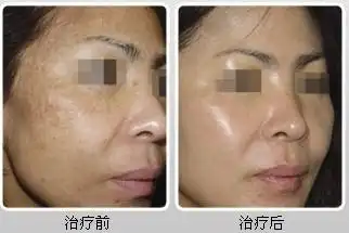 激光祛除黑色素成功的案例