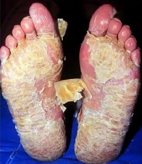 角化型脚气图片;告诉我可以吗