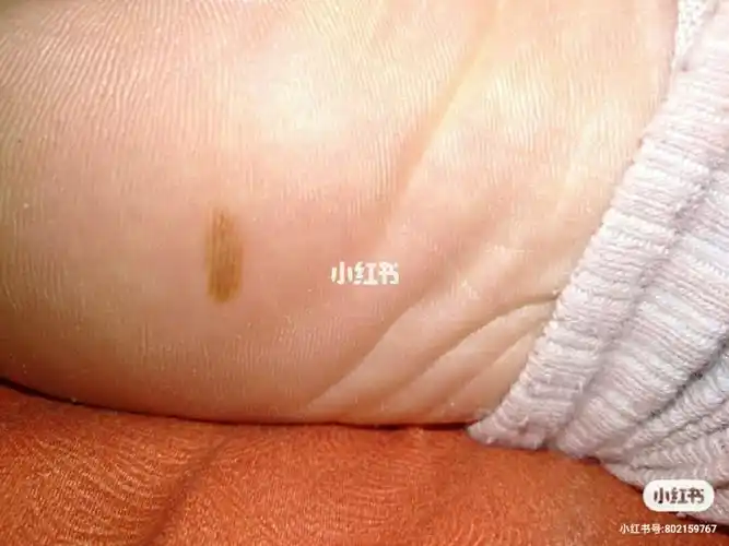 脚底痣后续来了