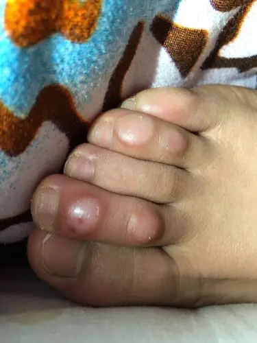 脚趾头上长了个茧一样的硬硬的疙瘩不疼不痒,像死皮一样,怎么才能去掉