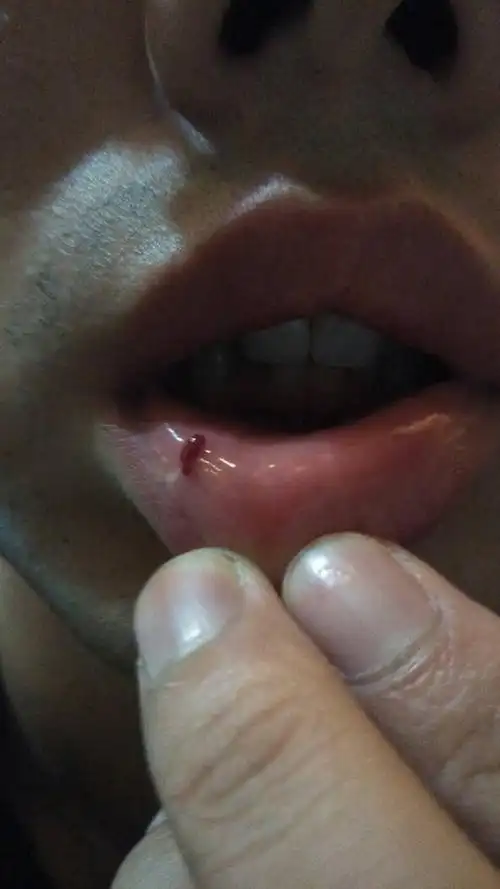 嘴唇内侧这是怎么回事?