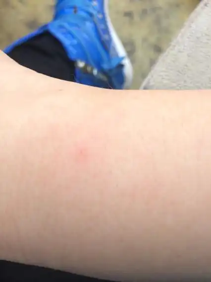 被猫小院餐厅的猫抓破皮但没流血,一个印子.需不需要去打针?