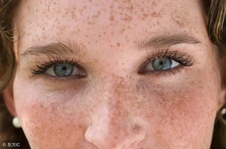 黄褐斑与晒斑的区别(晒斑和黄褐斑应该怎样区分开来呢)