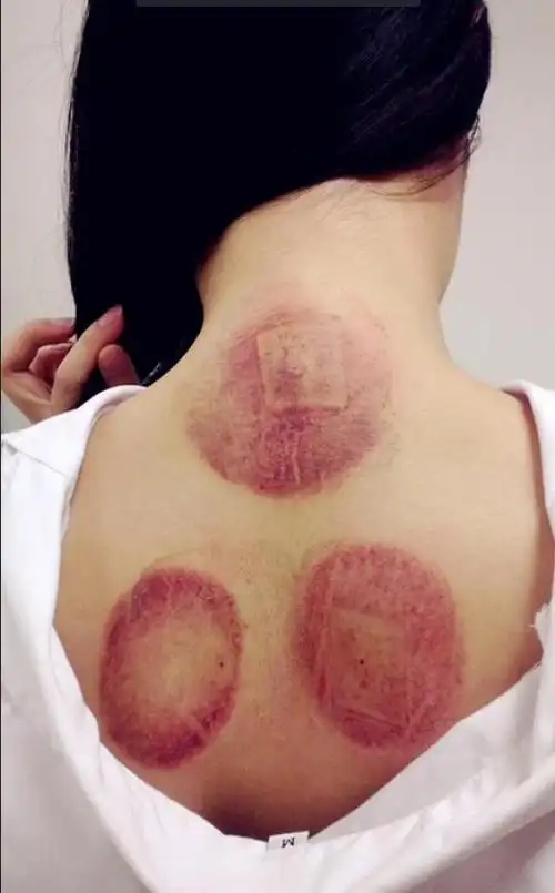 拔罐的好处和坏处(拔血罐的好处和坏处)-情感知识库-动动脑