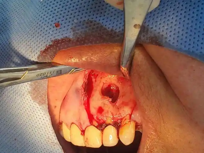 口腔外科方面:下颌骨巨大囊肿切除术手术中完整剥离囊壁.