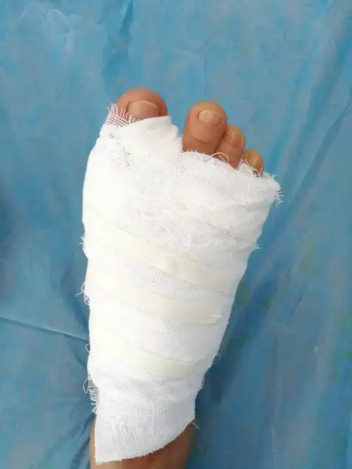 小手术有大讲究,大骨科手术与拇外翻手术的差别就好比是修闹钟和修