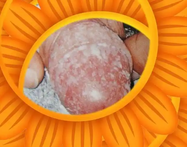 龟头龟头炎有哪些?我们把它分为6大类,32个疾病